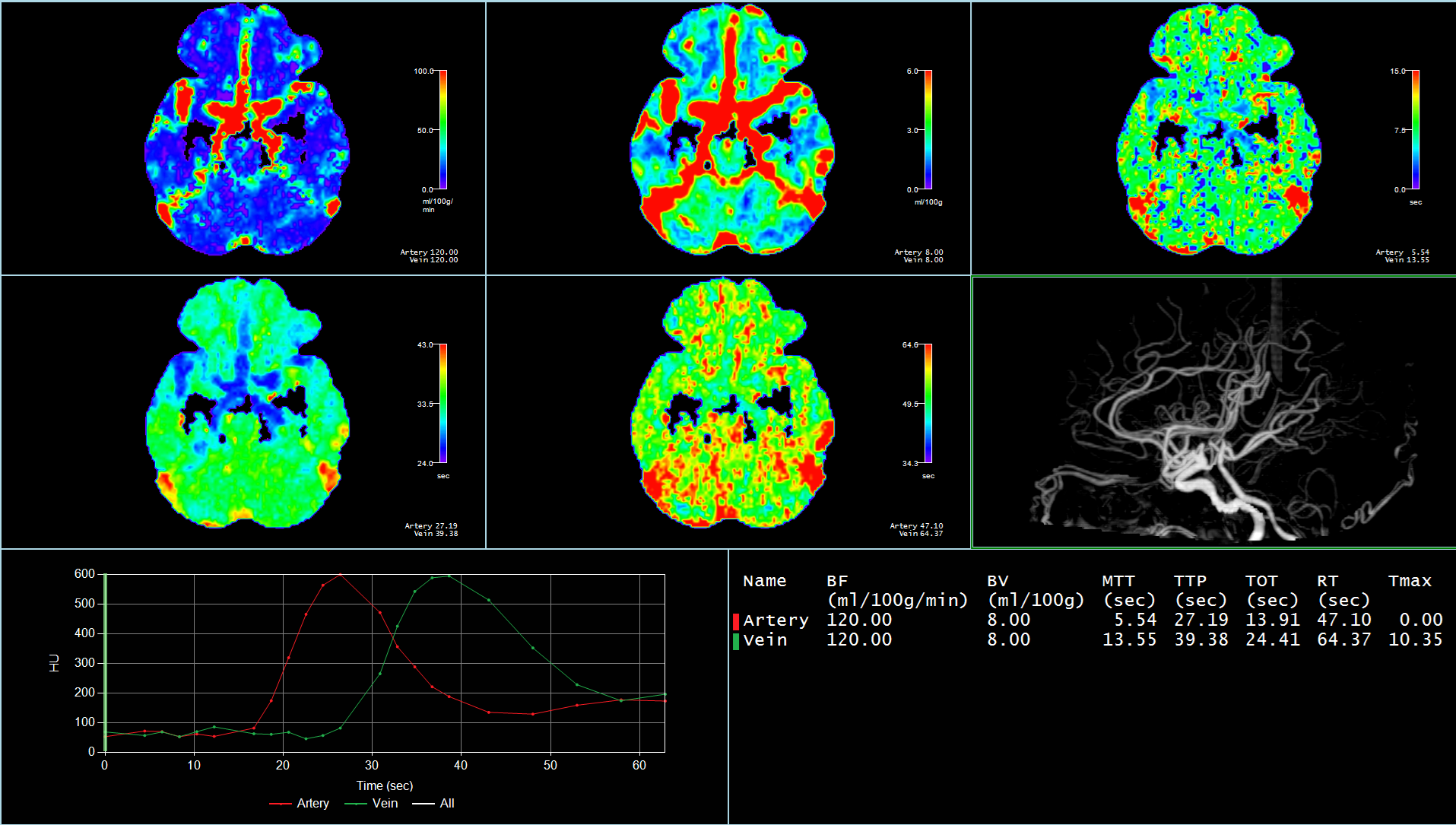 CT Neuro Perfusion 2