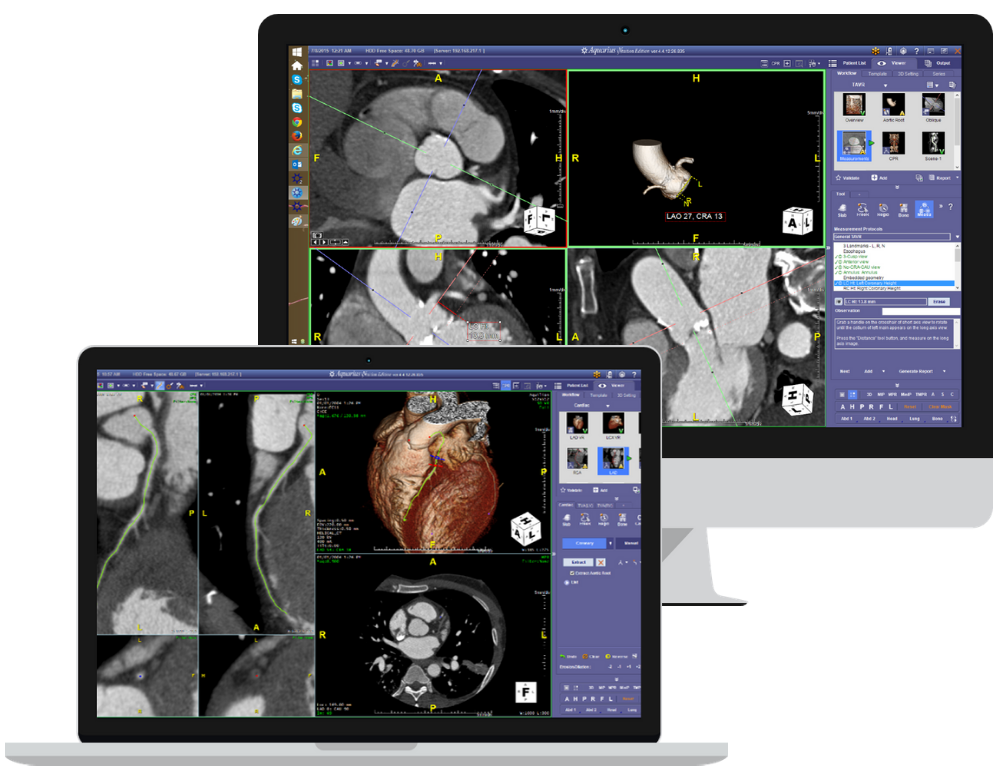 TeraRecon-Advanced Visualization-AI-Intuition-Radiology