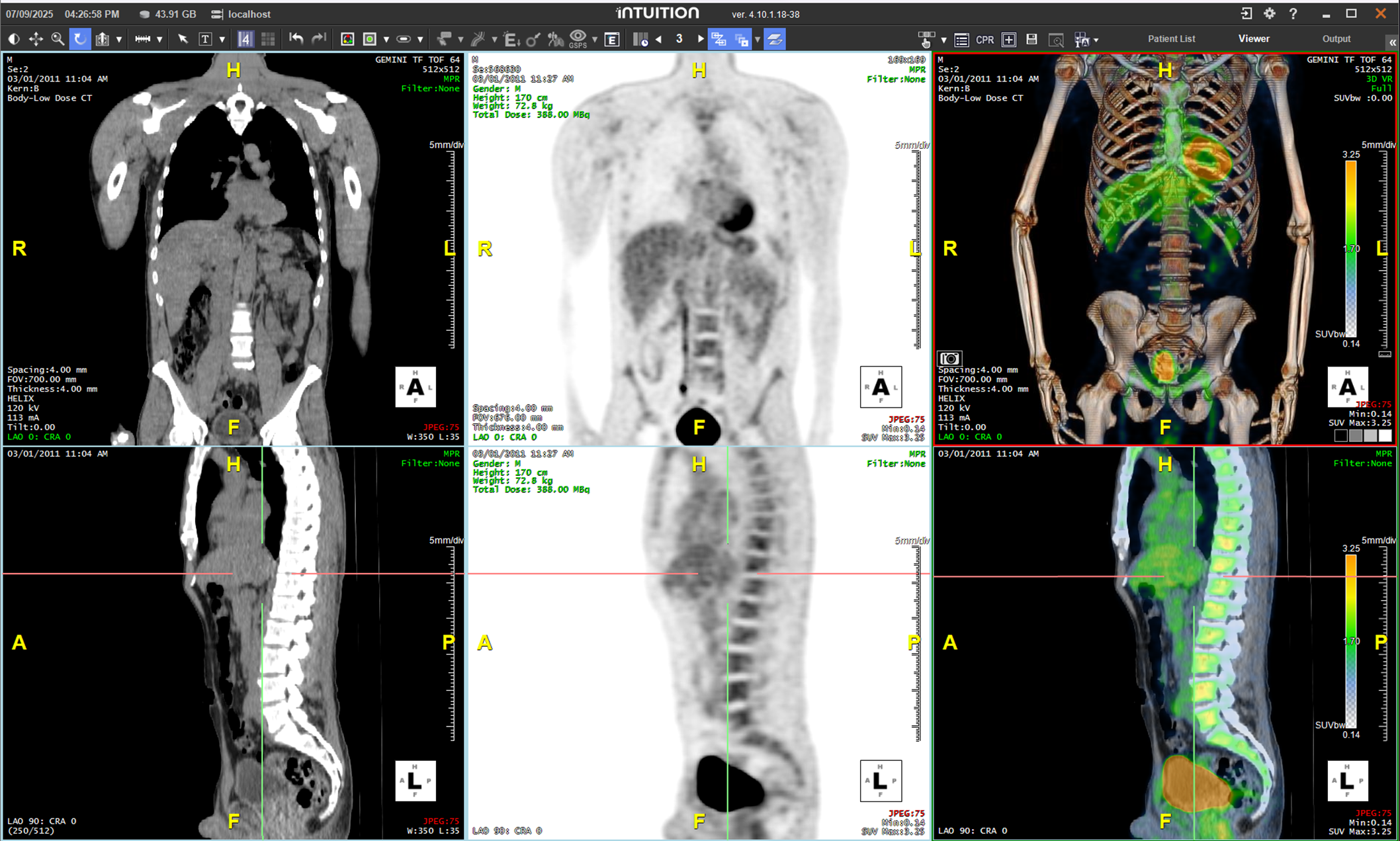 PET CT Fusion Cor Sag