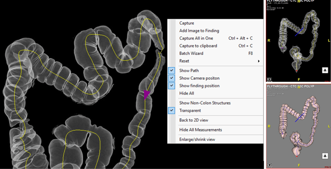 TeraRecon 4.4.13 (P4) Release Colon Flythrough Workflow Improvements 2,3,4