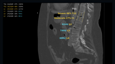 DETECT Bone density 16 x 9
