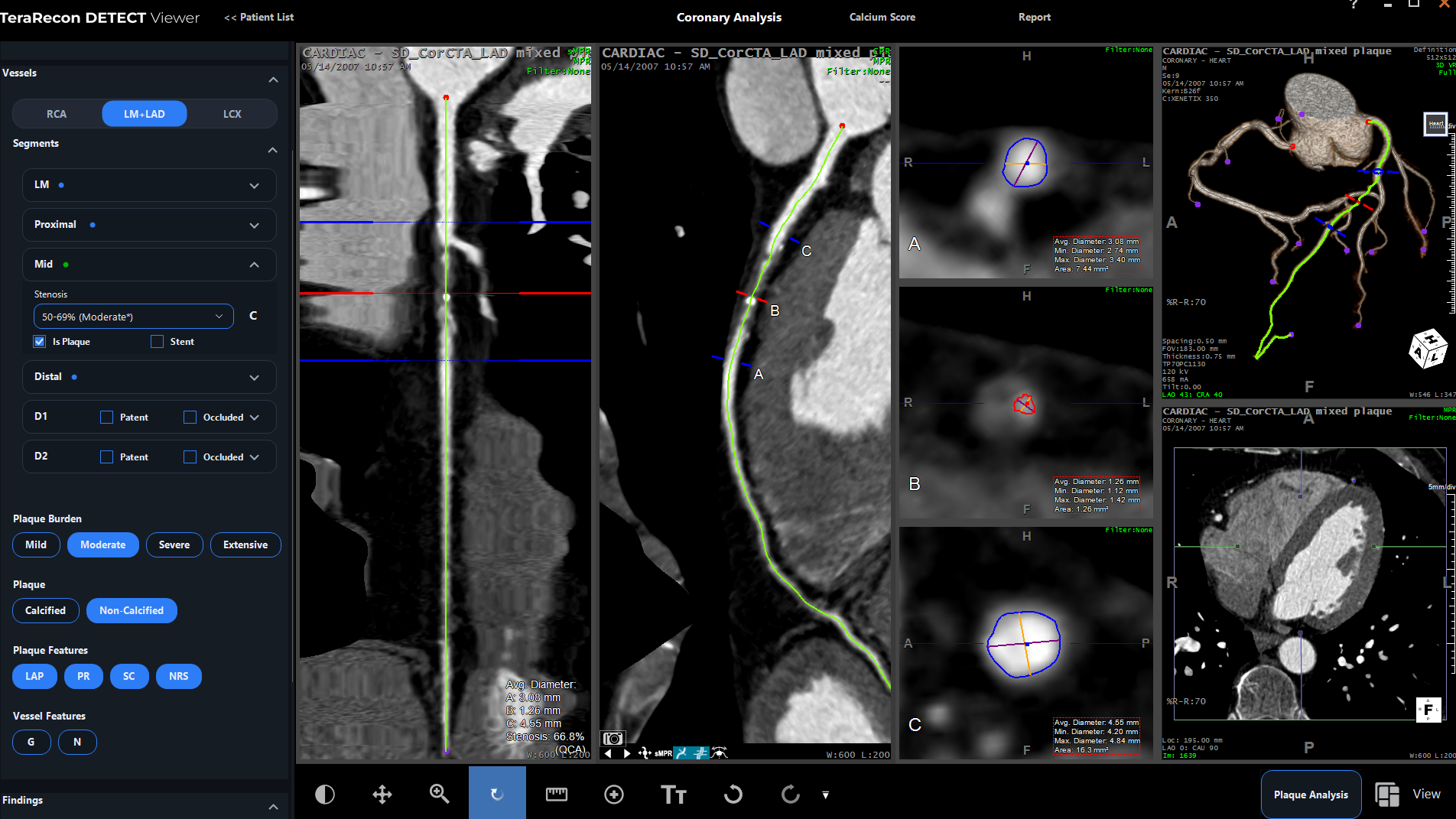 DETECT coronary workflow 16 x 9