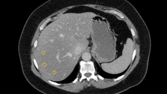 DETECT fatty liver 16 x 9