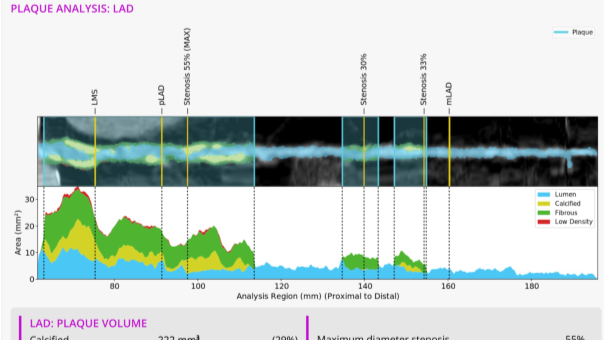 DETECT plaque analysis 16 x 9