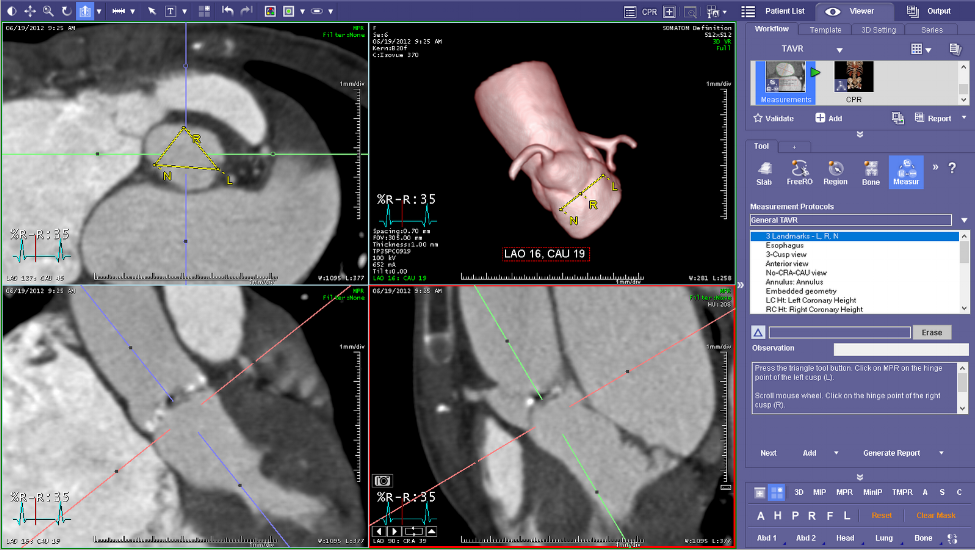 Guided and Customizable Aortic Annular Measurement Protocols