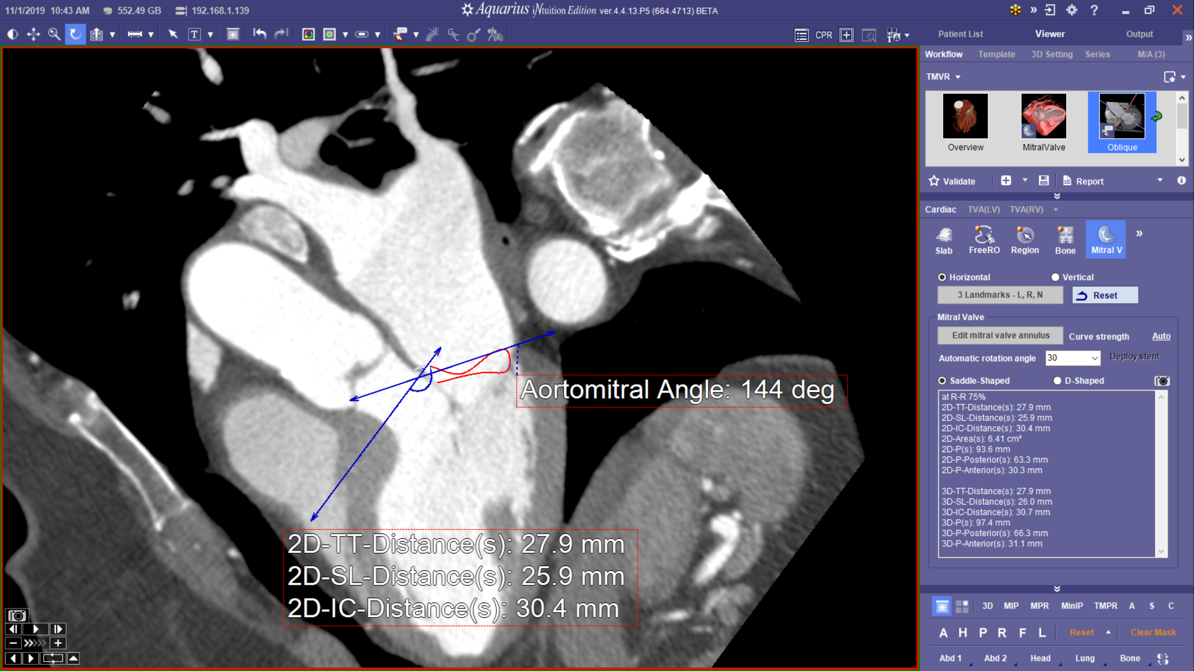 Key Measurement: Aorto-Mitral Angle