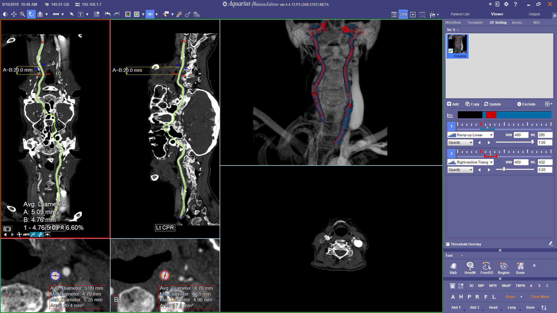 CT Head Neck