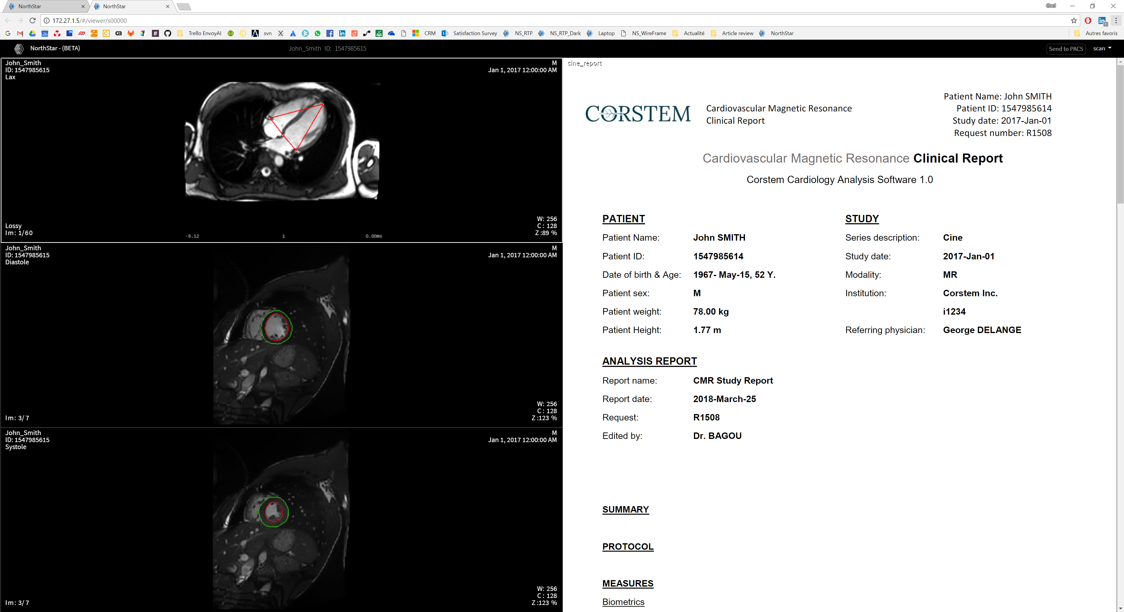 TeraRecon Debuts Next Generation Northstar™ AI Explorer at SIIM18