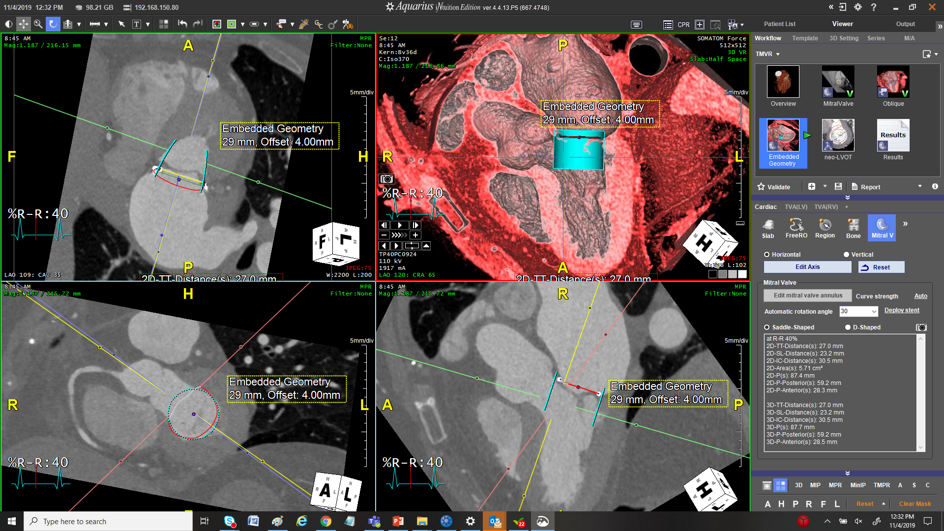 Embedded Geometry tools to visualize valve and stent placements. 