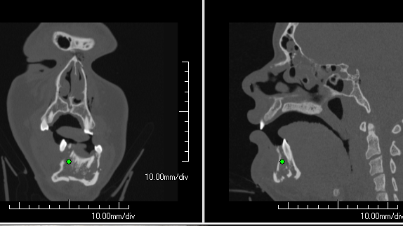 Cross-sectional multi-planar reconstruction-658333-edited