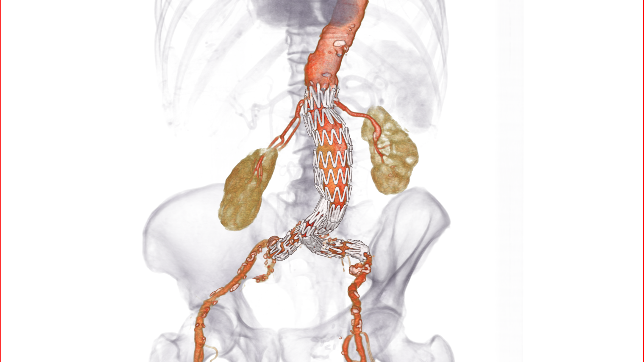 EVAR stent planning-417734-edited