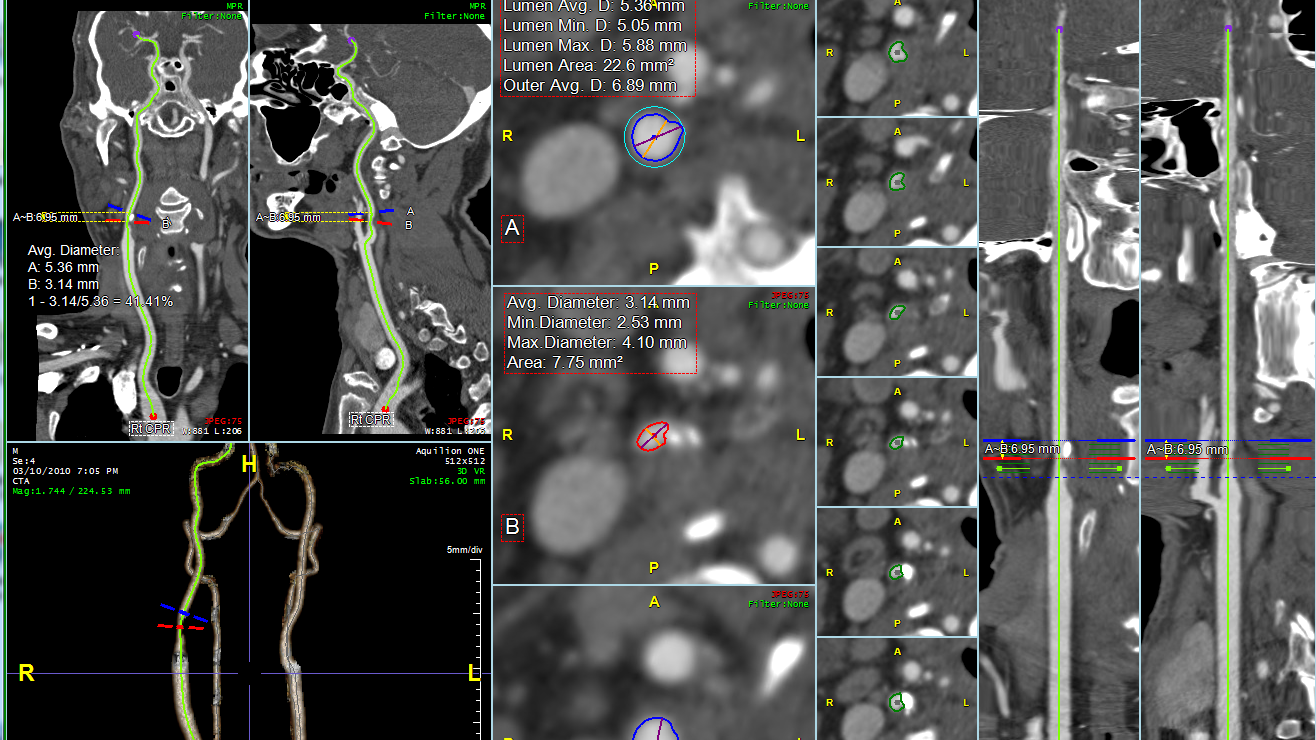 intervetional layout cpr batch and stenosis-054361-edited