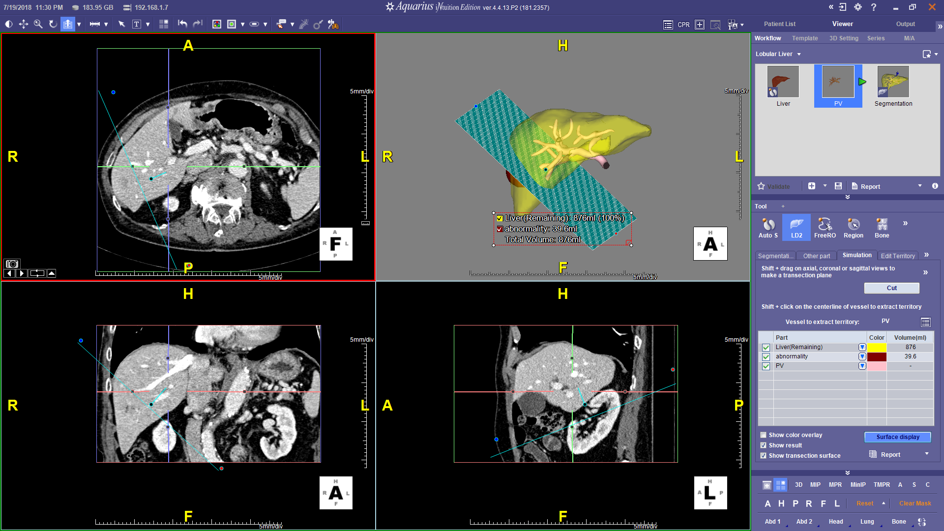 Liver Transection - Multiplanar Cutting Tool for Cut and Remaining Volumes