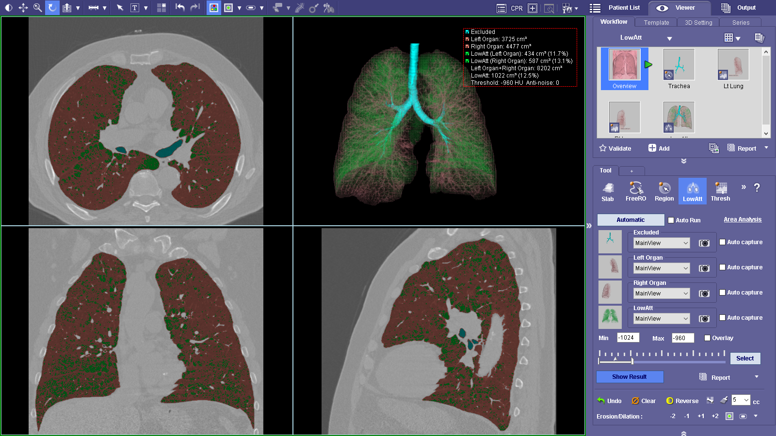 Lung segmentation-2