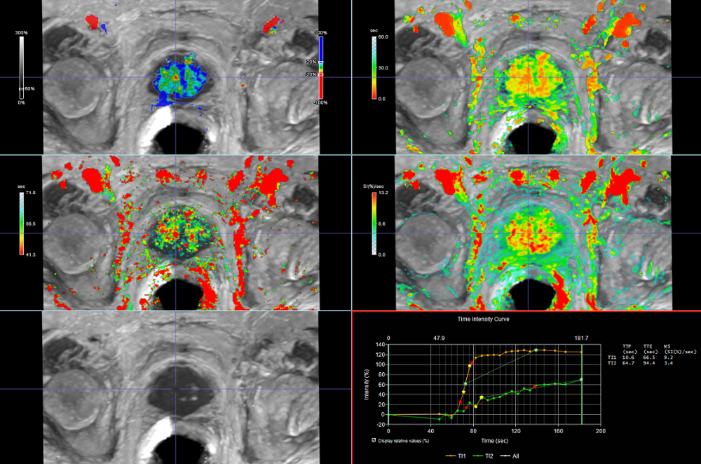 MR Prostate-2-1