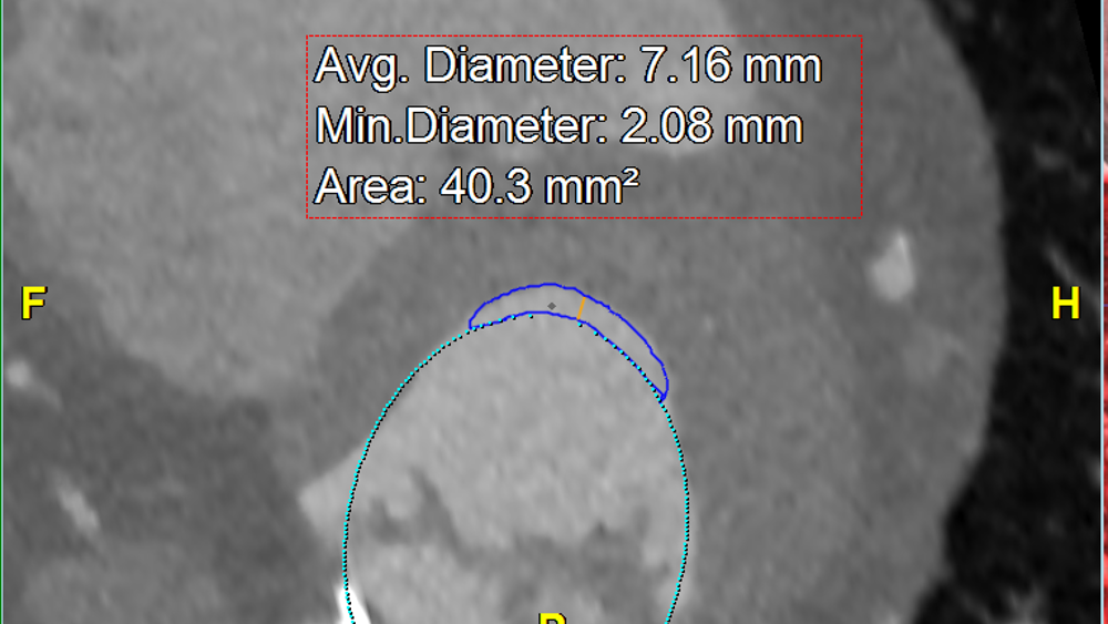 Neo-LVOT measurements for pre-surgical assessment--1