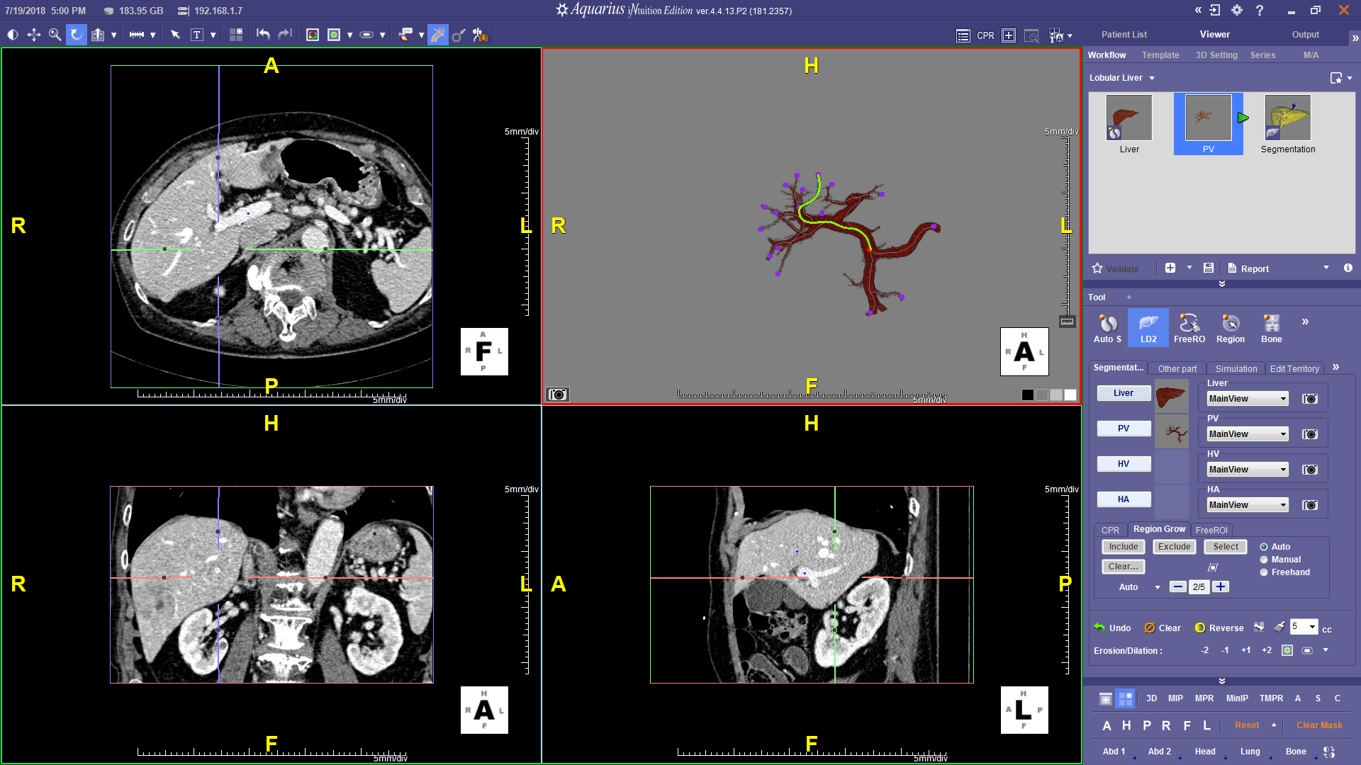 Guided Hepatic Vascular Segmentation and Assessment