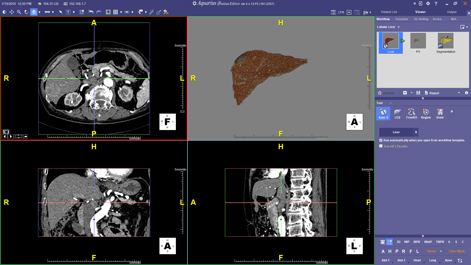 Pre-Processing and Automatic Liver Segmentation & Overview