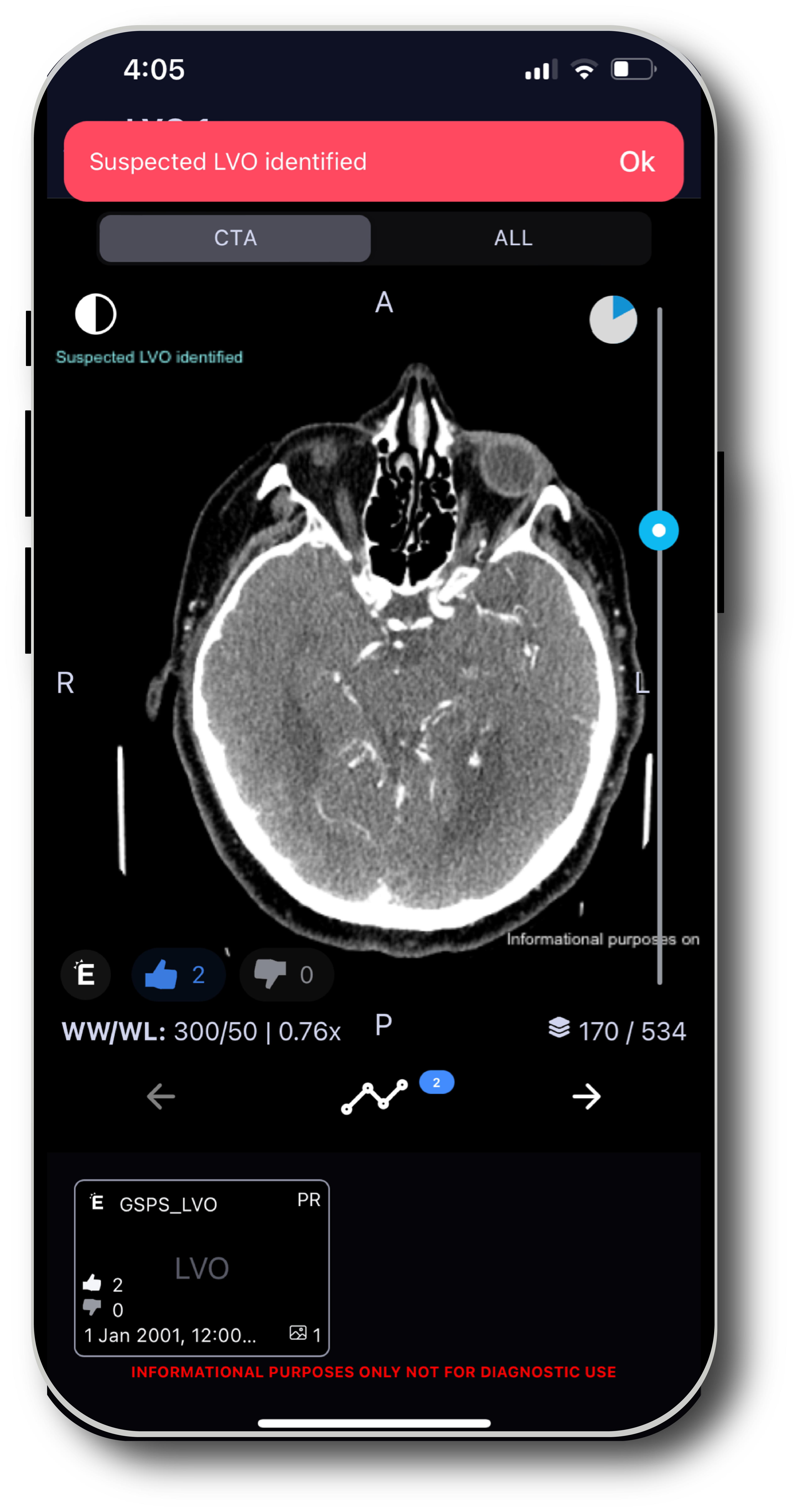 TeraRecon TR Neuro -Hero-Neuro-Mobile-LVO@4x