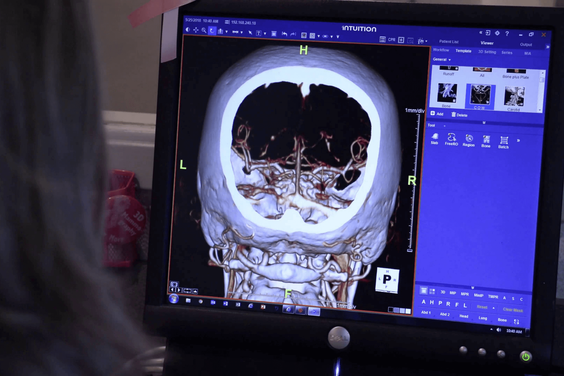 TeraRecon RSNA 2021 Demo 1(Slider Image) (1)