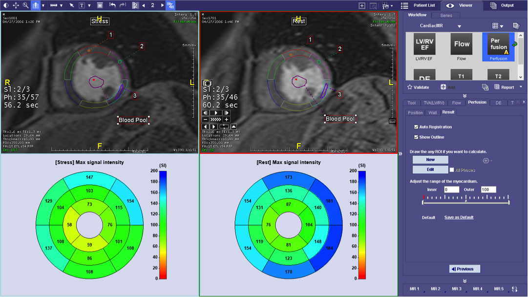 MR Cardiac Perfusion