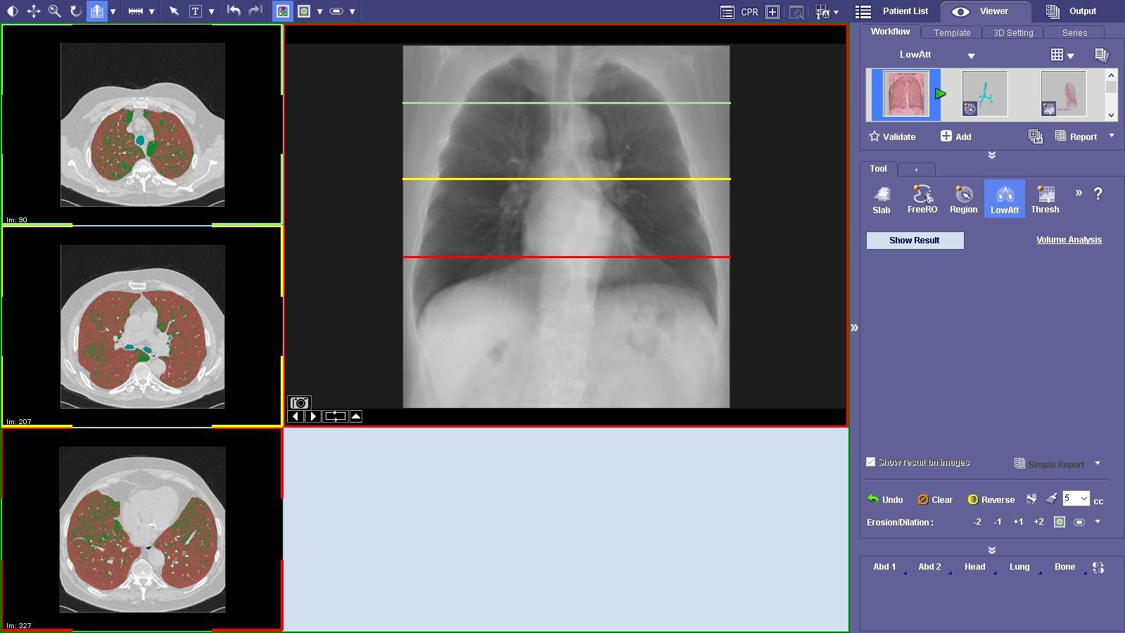 Low Attenuation Airway Evaluation