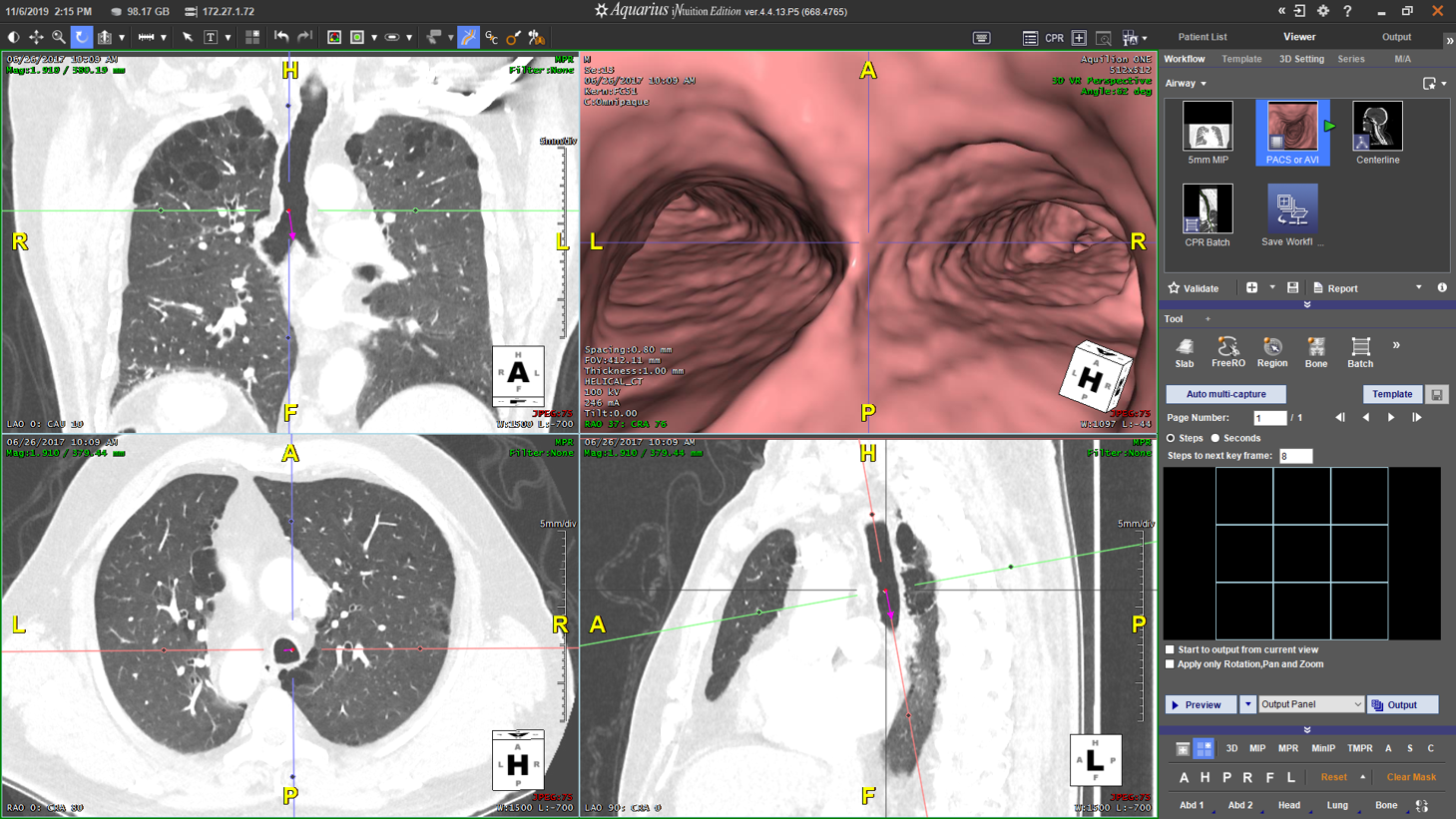 Airway Flythrough