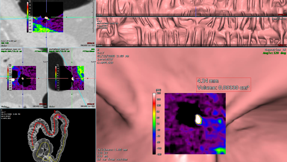 Colon Flythrough - Review, Analysis and Reporting