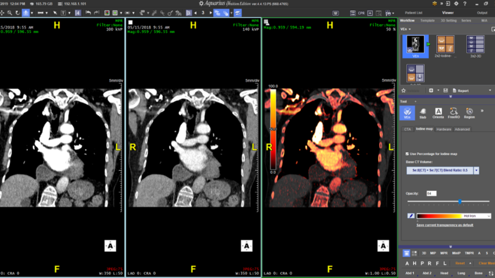 Multi-KeV - Iodine Mapping