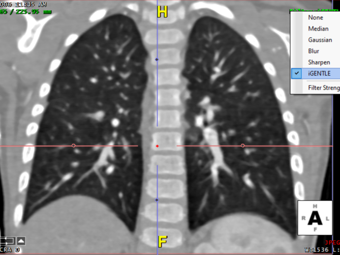 pediatricLung-2-1