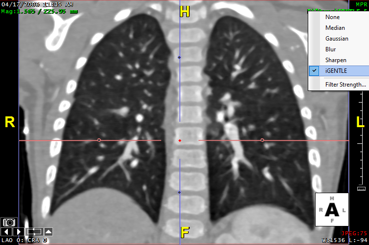 pediatricLung