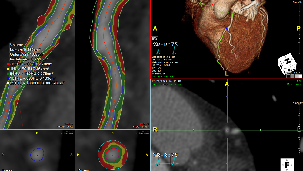 Coronary Evaluation: Plaque, Stenosis, Tortuosity/Curvature, etc.