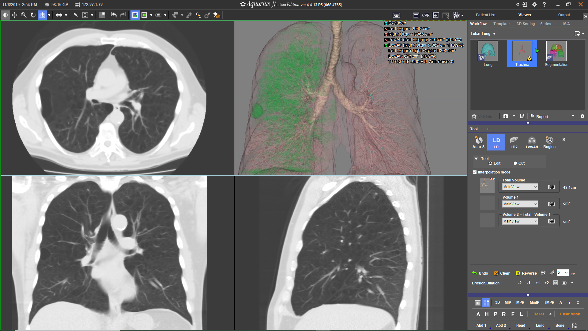 Guided pulmonary vascular segmentation and assessment