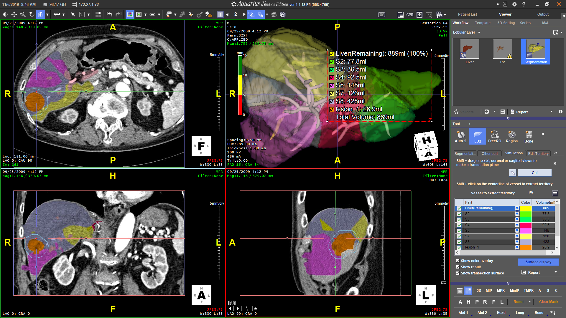 Liver Territory and Lesion Segmentation Volumes