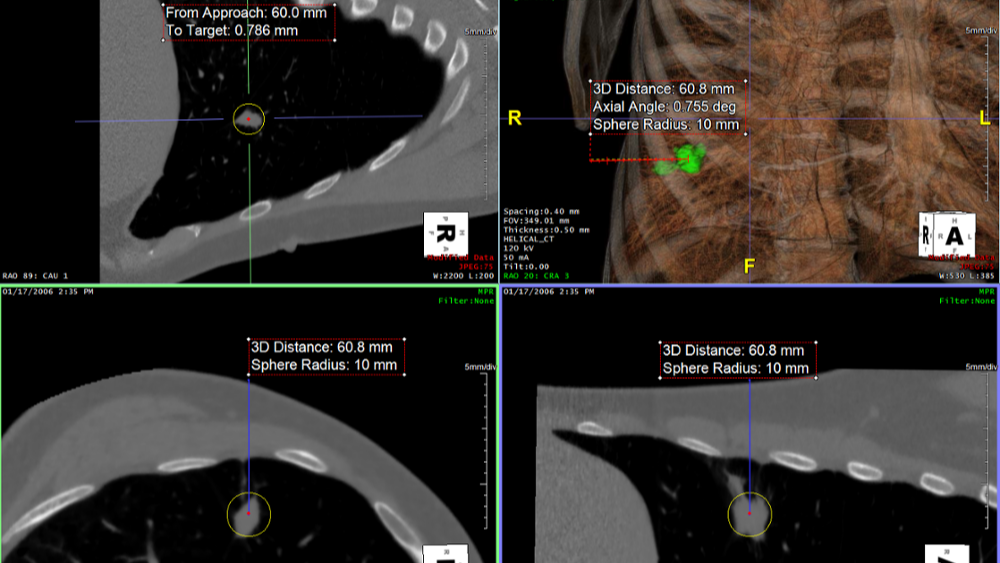3D Distance Tool for Virtual Biopsy