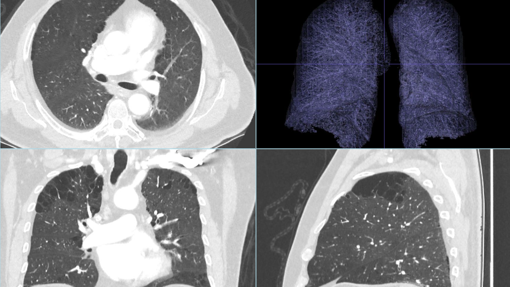 Pre-processing and Automatic Lung Segmentation and overview